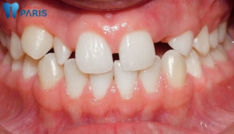 cách làm răng thưa khít lại tại nhà, răng thưa phải làm sao, răng thưa nên làm gì, răng thưa và hô, răng thưa thì sao, răng thưa và cách khắc phục, răng thưa thì phải làm sao