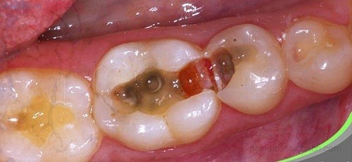 Cách khắc phục đau răng hàm là gì?