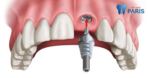 Trồng lại răng bằng phương pháp cấy ghép Implant mang lại khả năng ăn nhai hoàn hảo