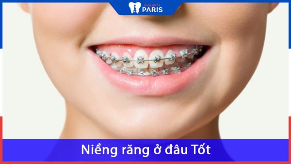 Niềng răng ở đâu Tốt – Uy Tín – Đảm Bảo Nhất Tp.HCM & Hà Nội