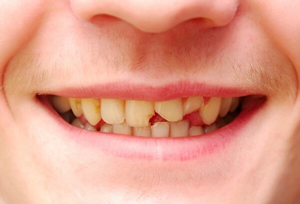 Răng mẻ có mọc lại không? Làm sao để khắc phục tình trạng mẻ răng?
