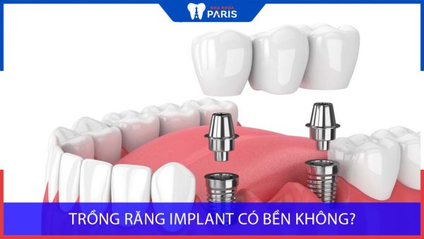 Trồng răng Implant có bền không? Tuổi thọ tồn tại được bao lâu?