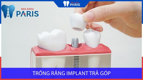 Trồng răng Implant trả góp và những thông tin bạn cần lưu ý
