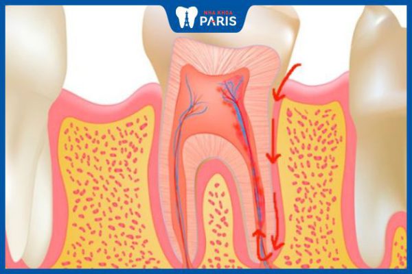 Viêm tủy răng ngược dòng – Bệnh lý NGUY HIỂM ai cũng nên biết!