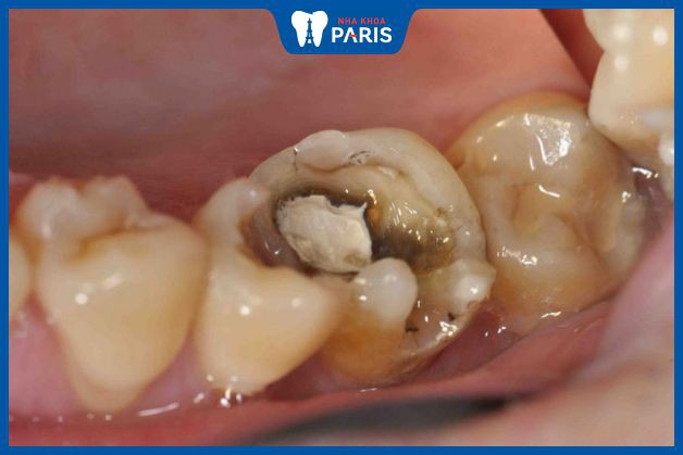 Đau do sâu răng có thể dùng một số bài thuốc mang tính sát khuẩn