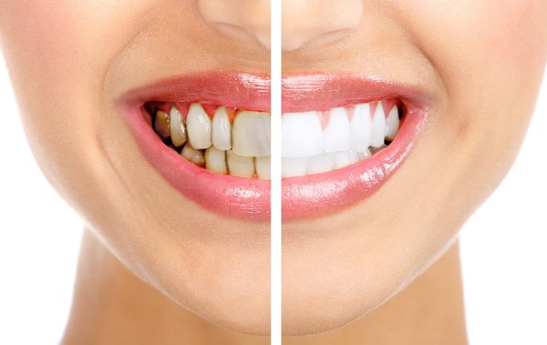Bọc răng sứ cho răng bị nhiễm tetracycline