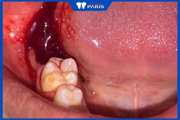 Một số biến chứng có thể xuất hiện sau khi thực hiện nhổ răng khôn