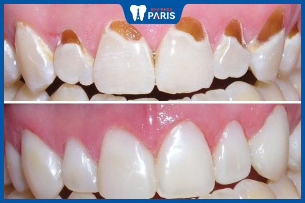 Trám răng cửa bị sâu - Phương pháp trị sâu răng ở giai đoạn nhẹ