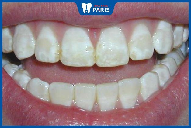 Răng cửa bị sâu sẽ khiến vi khuẩn xâm nhập phá hủy men răng làm răng yếu dần