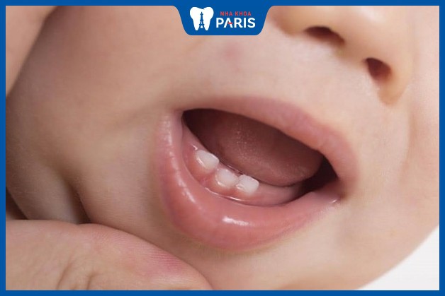 Vì sao trẻ mọc răng nanh trước răng cửa/răng hàm