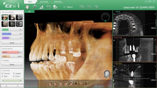 Hình ảnh răng khi trồng Implant thất bại