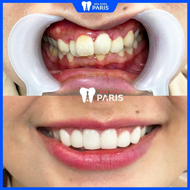 Hàm răng trước và sau khi bọc sứ của chị Nguyễn Đào Hạnh