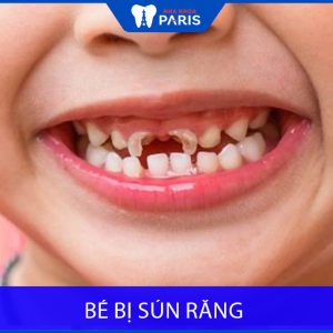 Sún răng là gì? Tác hại khi trẻ bị sún răng? Bác sĩ nha khoa giải đáp