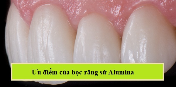 bọc răng sứ alumina, bọc răng sứ alumina có tốt không, bọc răng sứ alumina giá bao nhiêu