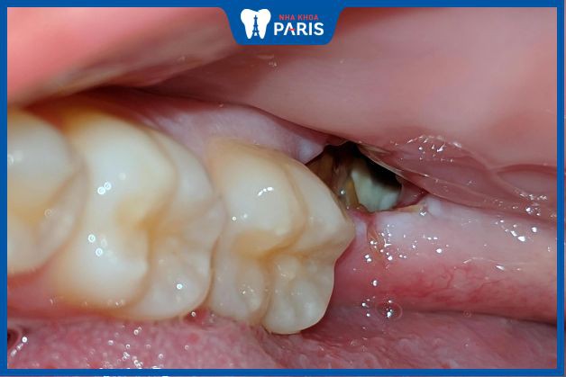 Khô ổ răng khôn dễ gặp và dễ gây biến chứng