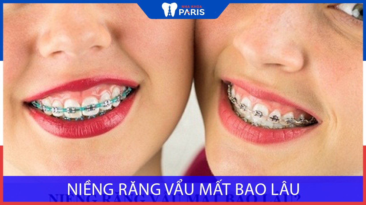 Niềng răng vẩu mất bao lâu? Tìm hiểu ngay giải pháp