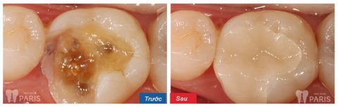 Kết quả hàn trám răng khắc phục viêm tủy cấp