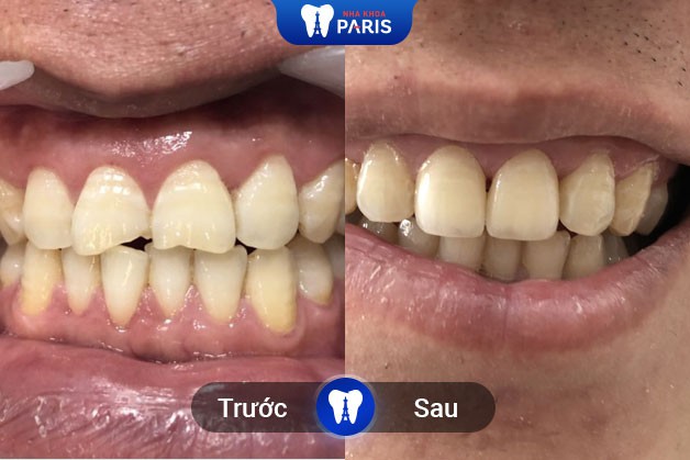 Khách hàng bọc sứ 2 răng cửa tại nha khoa Paris