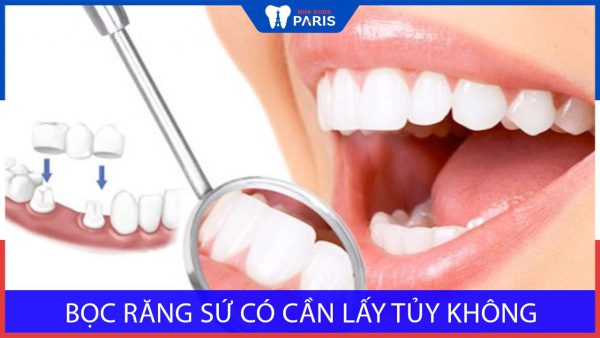 Bọc răng sứ có phải lấy tủy không? Lưu ý quan trọng