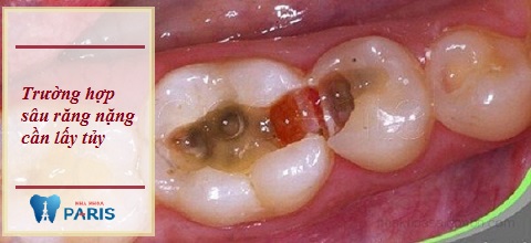 Sâu răng nặng dẫn tới viêm tủy 