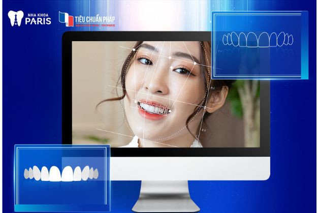 Nha Khoa Paris ứng dụng phần mềm thiết kế nụ cười vào dịch vụ bọc sứ
