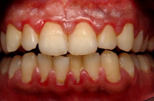 quy trình bọc răng sứ mất bao lâu