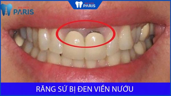 Răng sứ bị đen viền nướu là do đâu? Liệu có ảnh hưởng gì không?