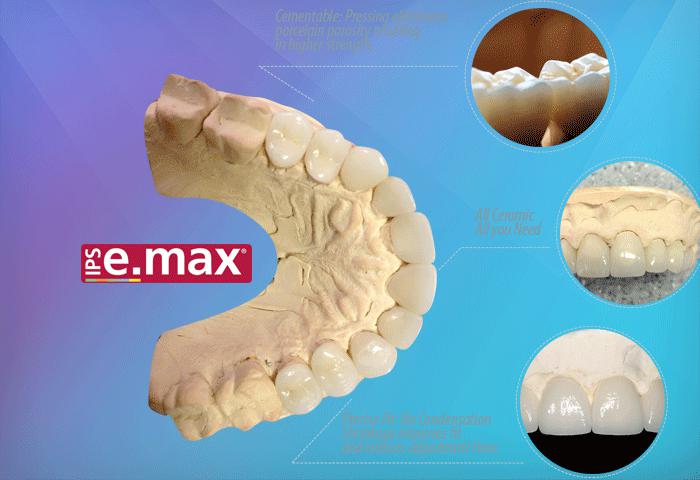 Răng toàn sứ Emax 
