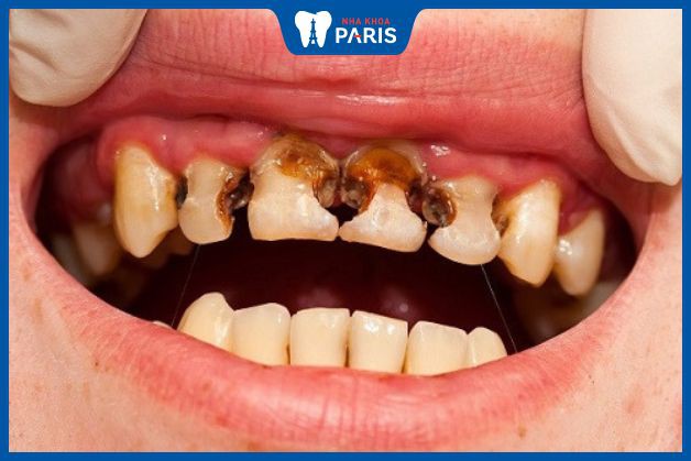 Sâu răng nặng là bệnh lý nguy hiểm, cần khắc phục sớm