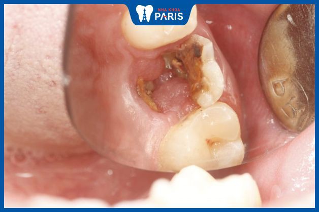 Vỡ răng hàm cần phục hồi sớm nhất có thể