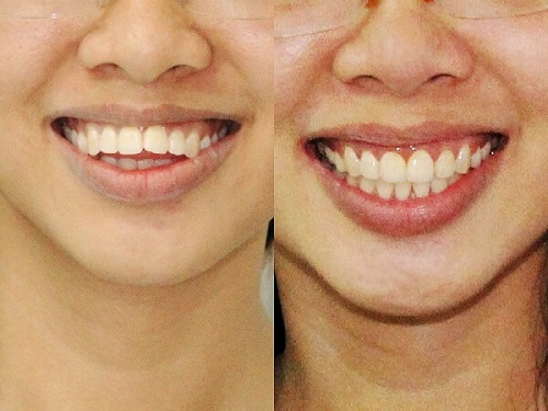  Trước và sau khi bọc răng sứ 