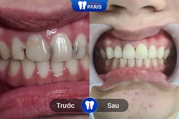 Khách hàng bọc răng sứ trị sâu răng