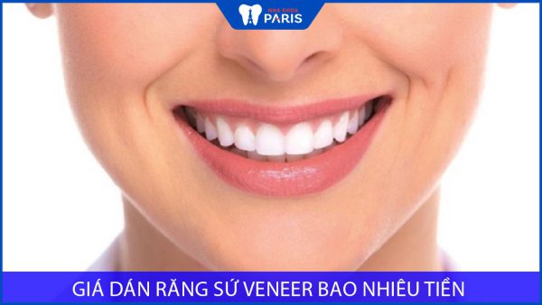 Giá dán răng sứ Veneer bao nhiêu tiền? Cách tối ưu chi phí