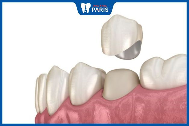 Giải pháp nào cho răng hàm bị sâu, bị vỡ đôi?