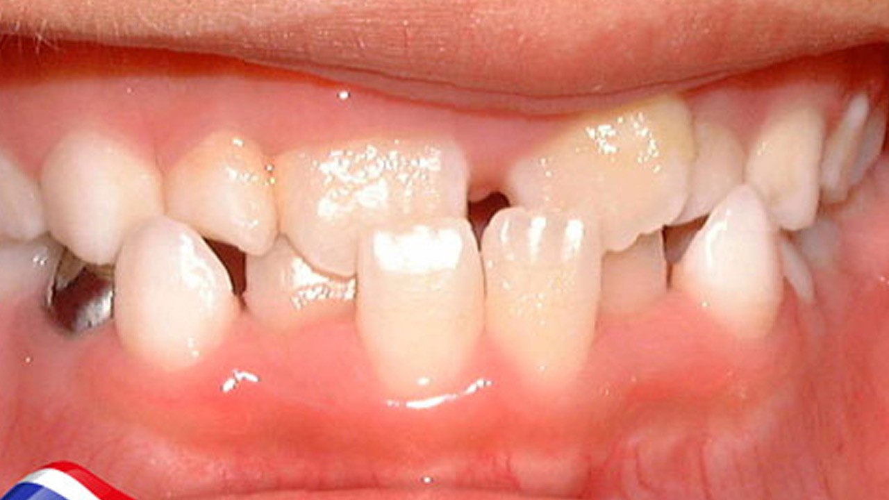 Khớp cắn chéo: Nhận biết và phương pháp điều trị hiệu quả