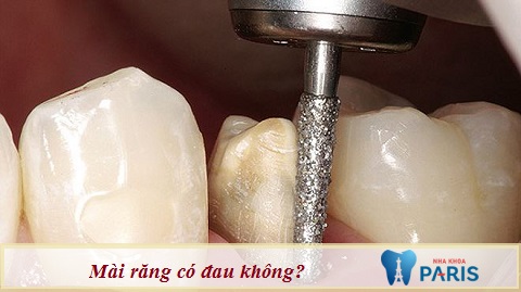 Mài răng có đau không, có gây ảnh hưởng gì không? | Phủ Răng Sứ Paris