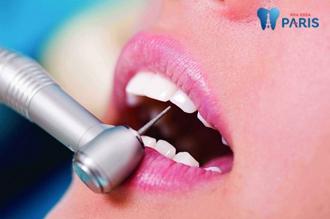Kỹ thuật mài cùi răng ảnh hưởng tới vấn đề: Mài răng có đau hay không