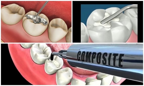 Trám răng thẩm mỹ - Giải pháp hoàn hảo giúp răng khiếm khuyết đều đẹp