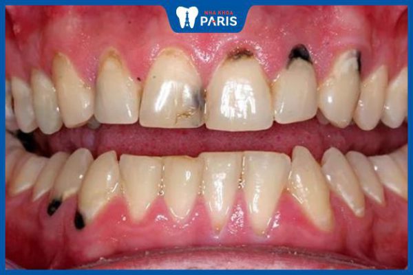 Sâu răng nhẹ – Những biểu hiện dễ nhận biết và cách khắc phục hiệu quả