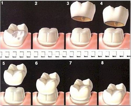 Chữa sâu răng nặng bằng bọc răng sứ