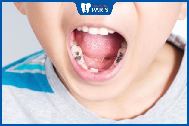Bé bị sâu răng hàm phải làm sao là nỗi lo lắng của nhiều bậc phụ huynh