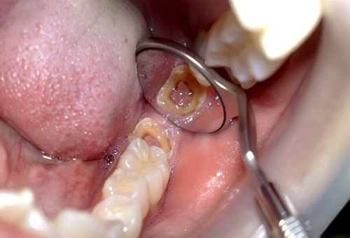 Bị vỡ răng hàm nên làm gì để khắc phục?