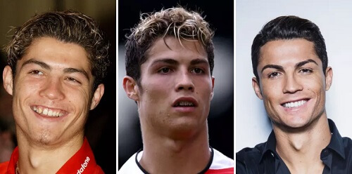 khuôn mặt Ronaldo trước và sau khi niềng răng thành công