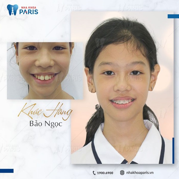 Khách hàng Bảo Ngọc sau 5 tháng sử dụng dịch vụ niềng răng trả góp Hà Nội tại Nha Khoa Paris