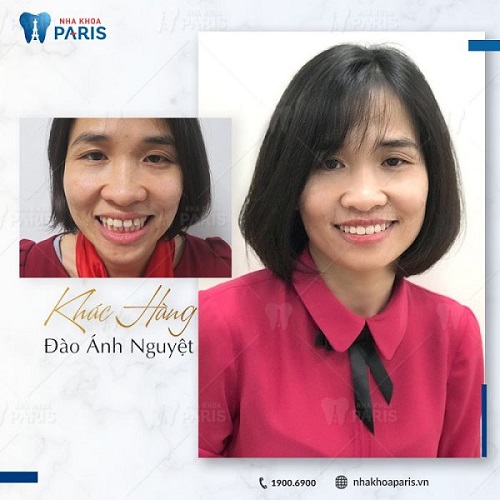 Khách hàng Đào Ánh Nguyệt sử dụng dịch vụ niềng răng invisalign trả góp tại Hà Nội