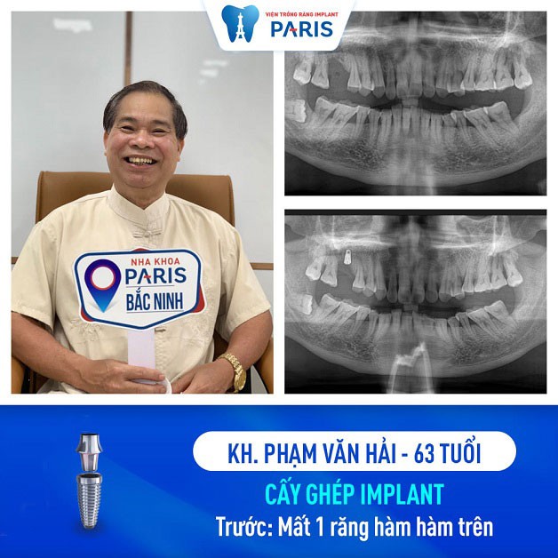 Bác Nguyễn Văn Hải trồng răng tại nha khoa Paris