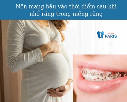Niềng răng bao lâu thì nên có bầu