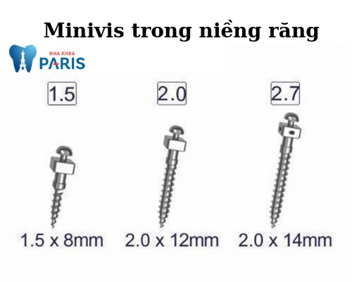 Minivis có đường kính từ 1,4 – 1,6 mm và chiều dài từ 6 – 12 mm