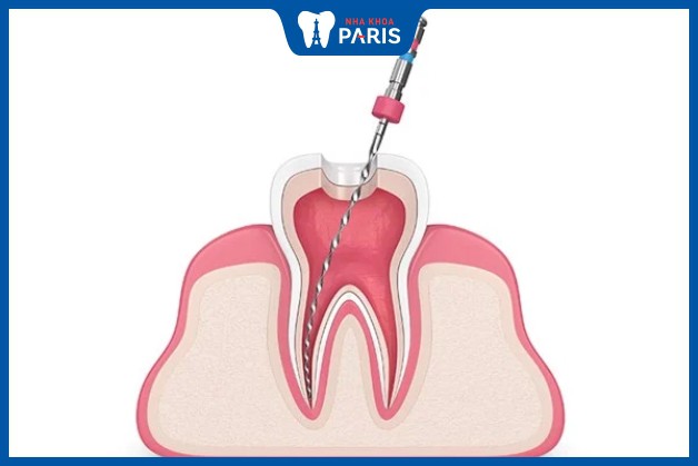 Lấy tủy răng đau cỡ nào trong từng giai đoạn