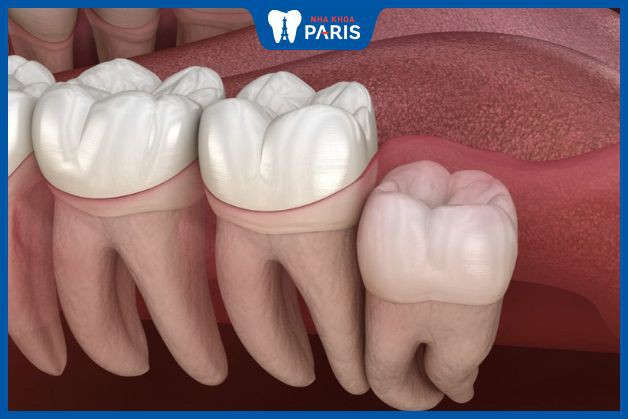 Nhổ nhiều răng khôn thường là trường hợp răng mọc thẳng